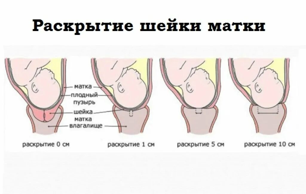 Раскрытие шейки матки при родах. Короткая шейка матки 2 см. Период раскрытия шейки матки. Раскрытие шейки матки перед родами. Шейка готова когда роды