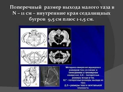 Поперечный размер таза входа
