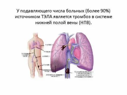 Причины тромбоза