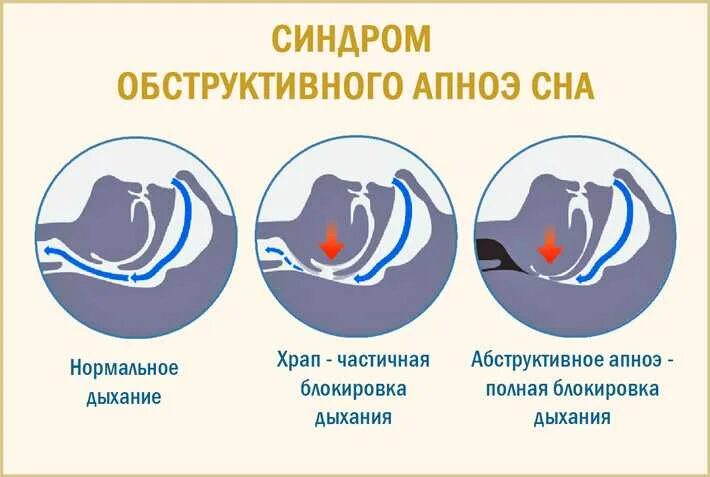 Синдром обструктивного апноэ сна. Синдром обструктивного апноэ/гипопноэ сна. синдром обструктивного ап ноя сна. обструктивное и центральное апноэ сна.