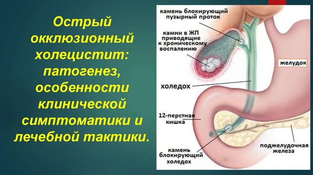 Острый калькулезный холецистит. Остром и хроническом холецистите. Острый холецистит обострение. Про холецистит острый холецистит.