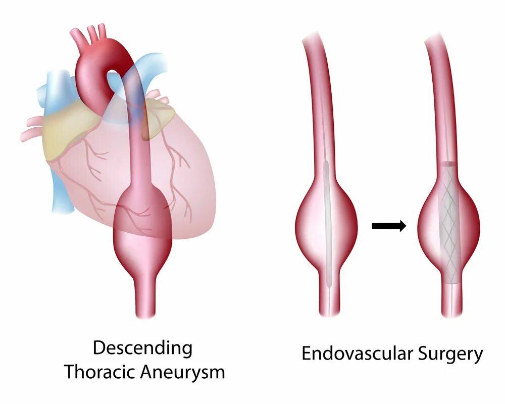 Аневризма сердца что это такое симптомы