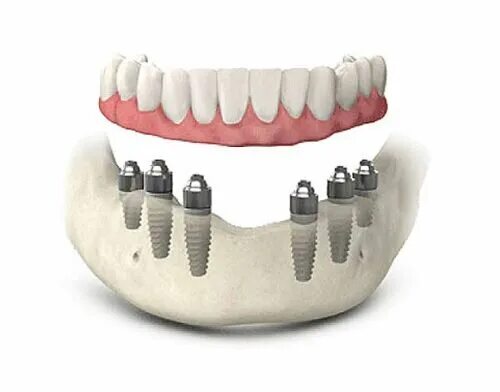 Имплантация Алл 6 зубов. Протез на 6ти имплантах. Несъёмный протез на 6 импланта х. Имплантация зубов all on 6