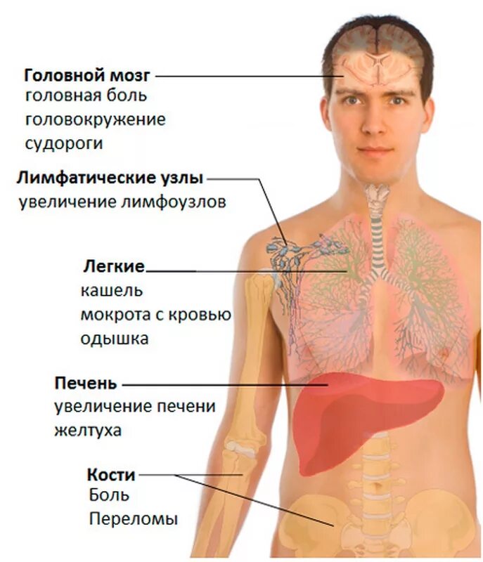 Ноющая боль в легких. Основные места метастазов.