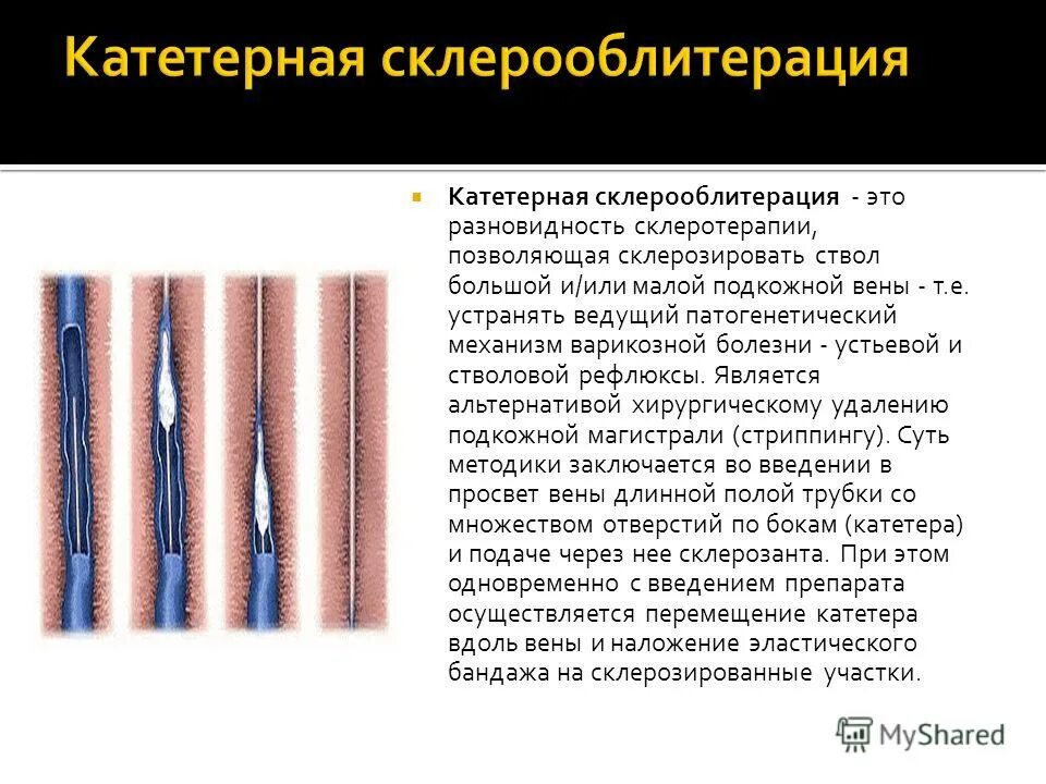 Склероскопия. Катетерная склерооблитерация. Склерооблитерация вен. Склеротерапия (склерооблитерация) вен. Стволовая склеротерапия.