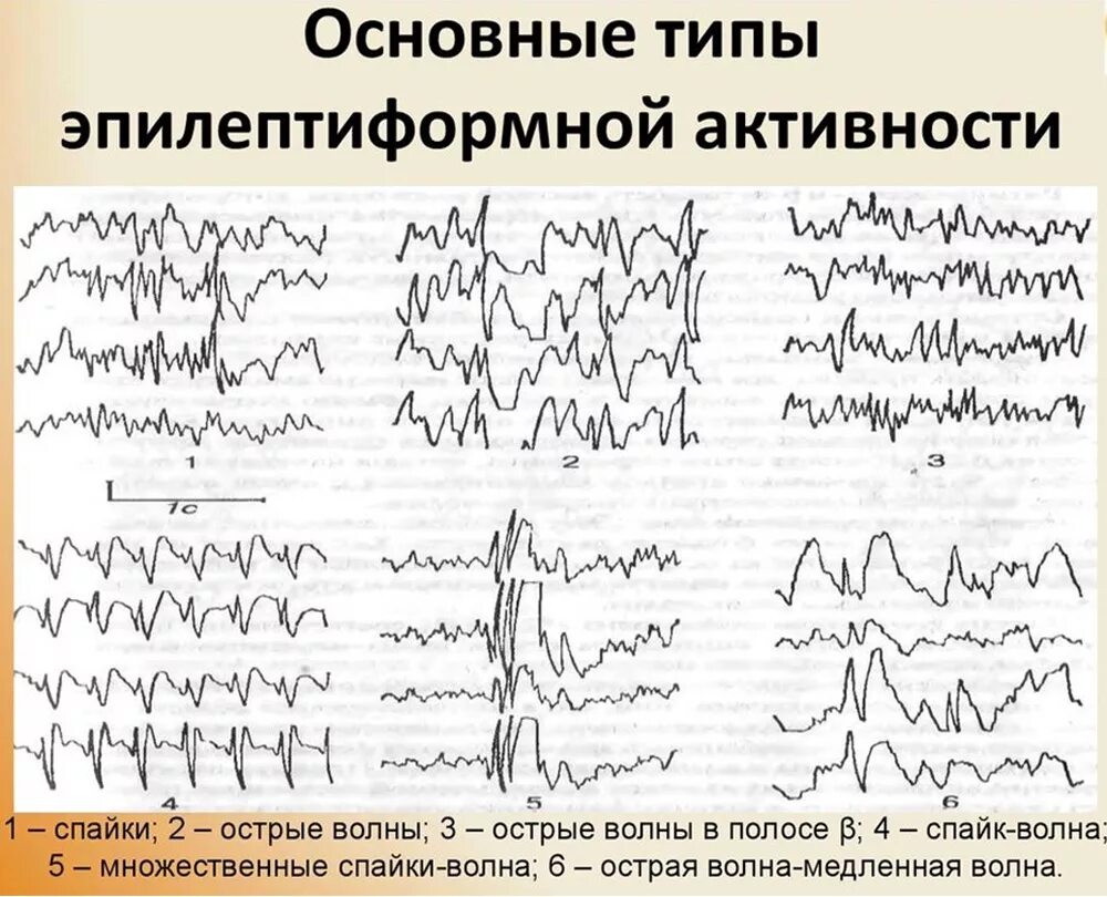 О чем говорит ээг. Эпилептиформные паттерны на ЭЭГ. Эпилептиформная активность на ЭЭГ. Как выглядят эпи волна на ЭЭГ. Генерализованная эпилептиформная активность на ЭЭГ У ребенка.