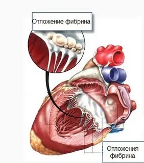 Ревматизм сердца