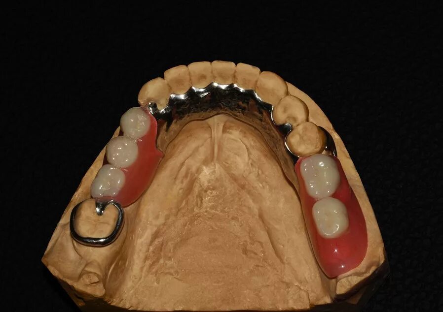 Бюгельный протез цельнолитой Базис. Бюгельные протезы Базис. Бюгельные протезы дуги. Моделирование базиса бюгельного протеза. Бюгельное лабораторный этап