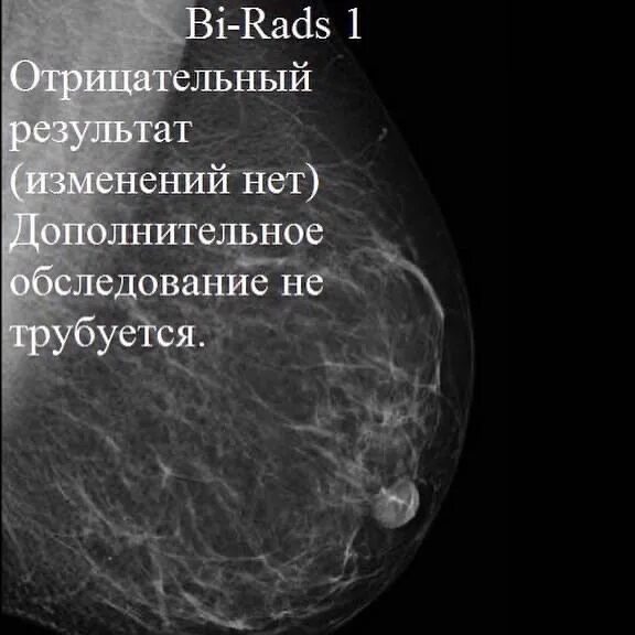 Фиброзно кистозная мастопатия молочной железы bi-rads-4a. Маммография молочных желез bi rads 1. Маммография молочных желез bi rads 4. Bi-rads 3 молочной железы маммограмма. Bl rads 2