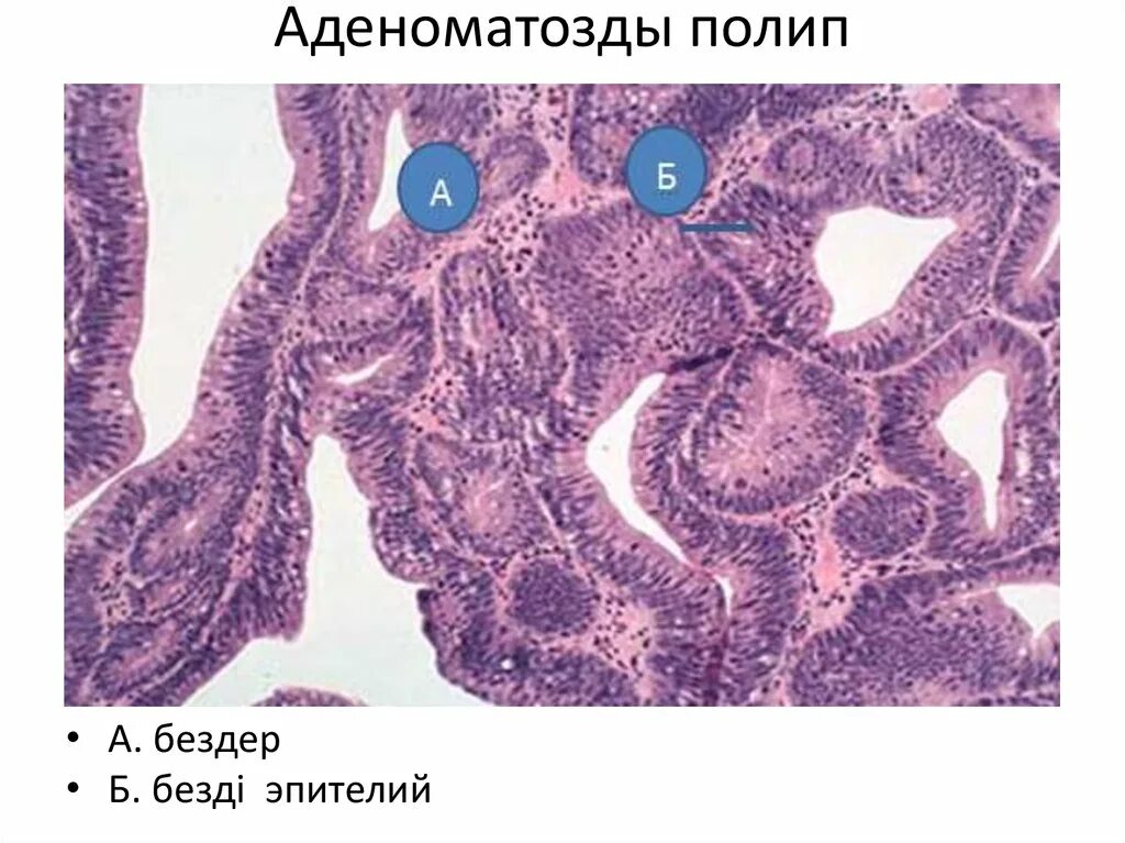 Микровезикулярный полип толстой кишки. Аденоматозный полип толстой кишки гистология. Аденоматозные полипы эндометрия гистология. Полип толстой кишки микропрепарат. Полип эндометрий гистология.