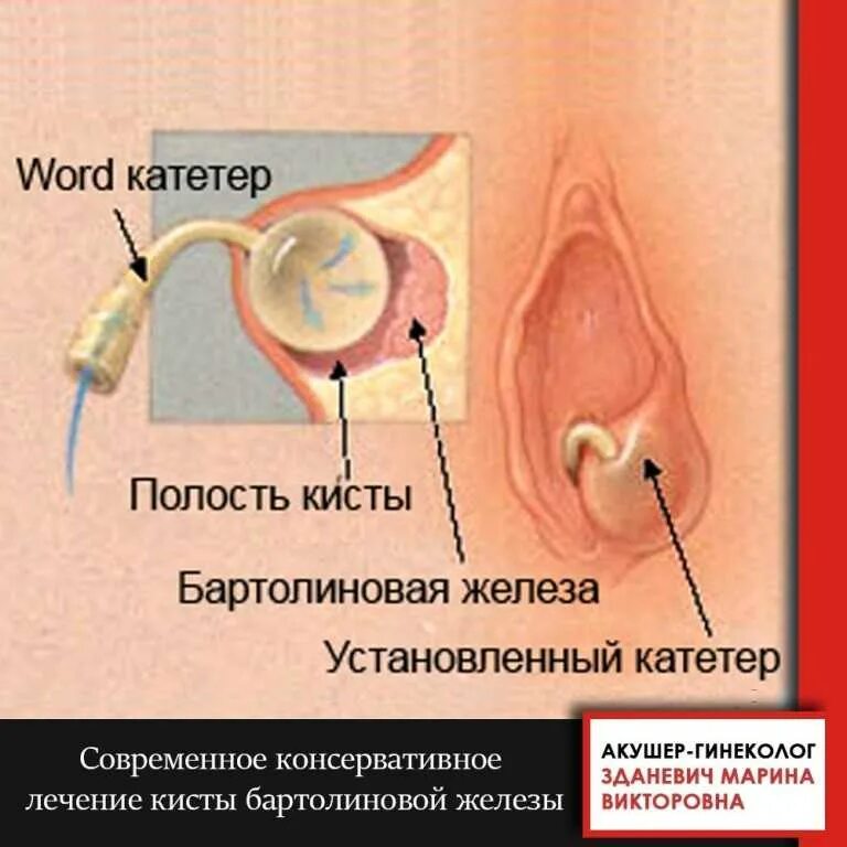 Катетер бартолиновой. Word катетер бартолиновой железы. Бартолинит ворд катетер. Ворд катетер бартолиновой железы. Кистабартоливойжелезы.