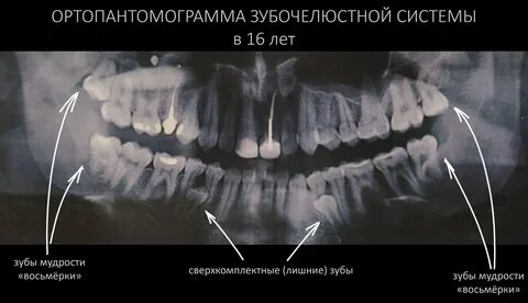 Зачаток восьмерки