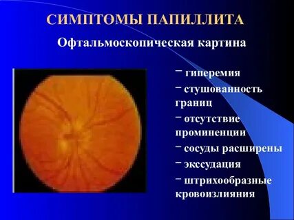 Папиллит