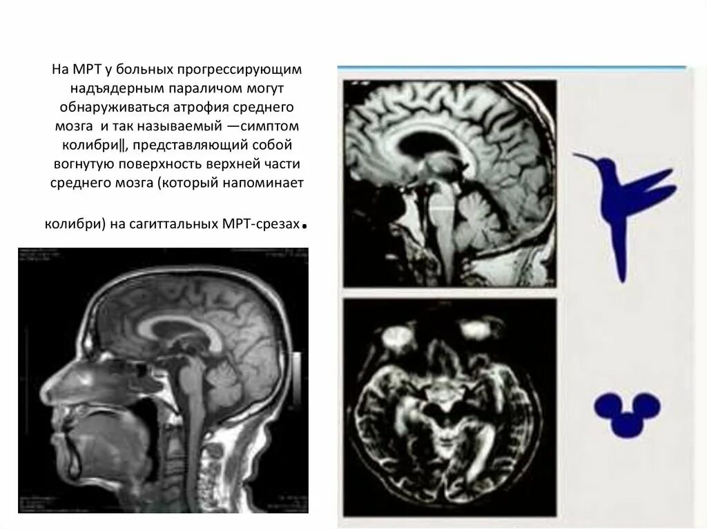 Атрофия головного мозга лечение. Синдром стила-Ричардсона-Ольшевского мрт. Прогрессирующий надъядерный паралич симптомы. Мрт при надъядерном параличе. Ядерный прогрессирующий паралич.