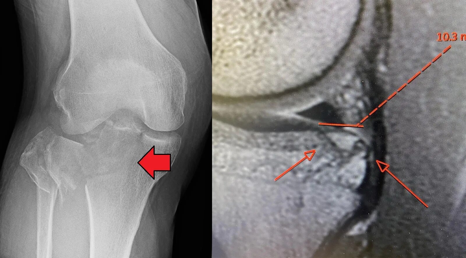 Fracture c