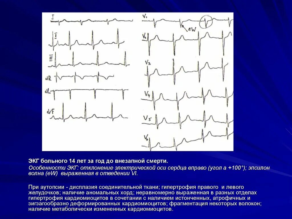 Отклонение от оси сердца вправо на ЭКГ. Отклонения в ЭКГ сердца. Отклонение Эл оси вправо ЭКГ. Отклонение ЭОС вправо на ЭКГ У ребенка. Сердце отклонено вправо
