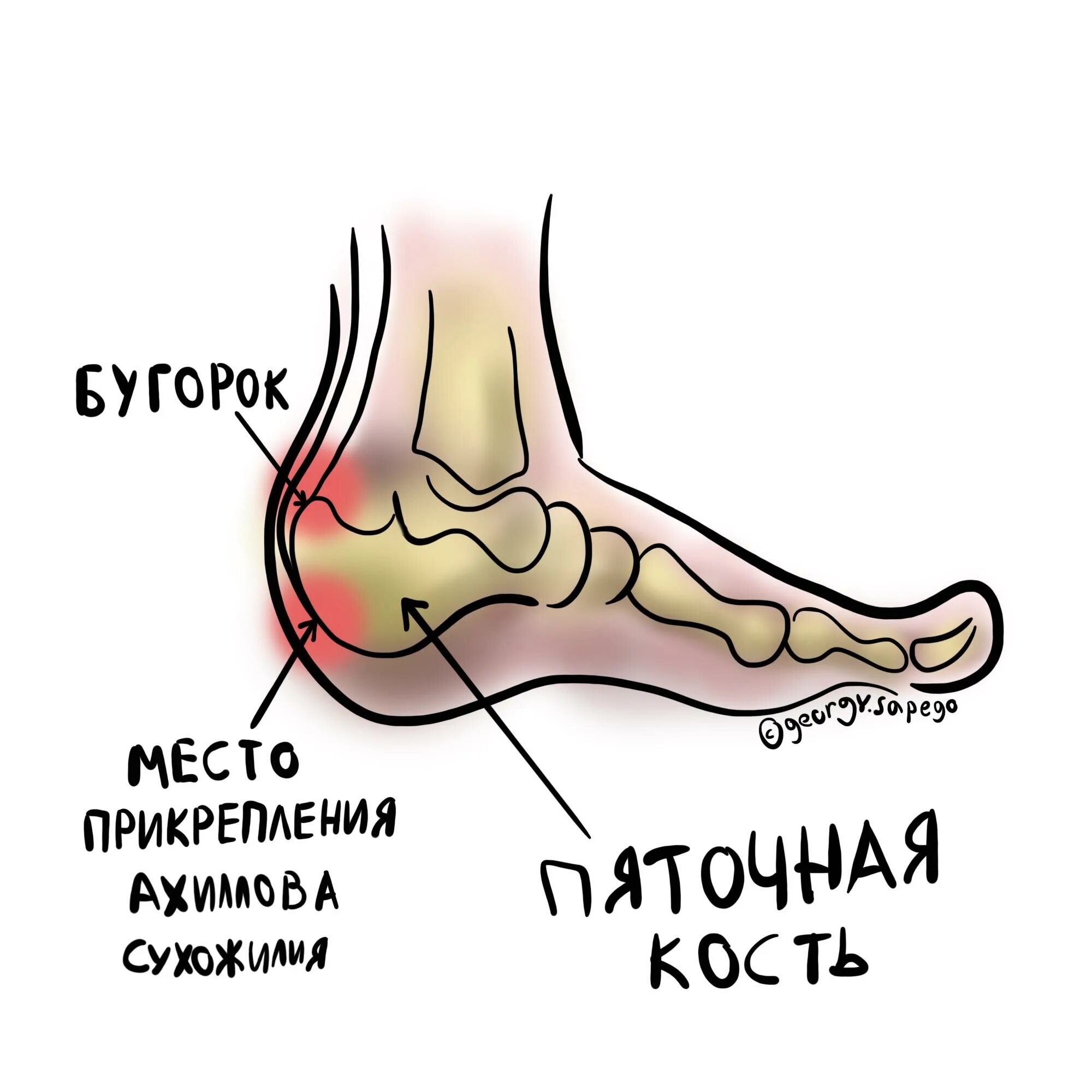 Сильные боли в пятке при ходьбе