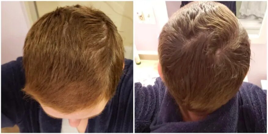 Рост волос после химиотерапии. Волосы после химиотерапии. Причёски для мальчиков для отращивания волос. Волосы после химиотерапии фото. Волосы после химии терапии.