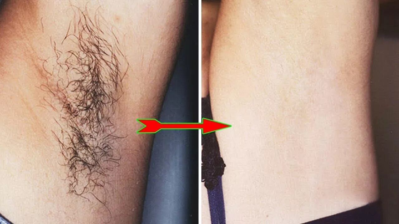 Какая эпиляция для светлых волос. Депиляция. лазерная эпиляция. электроэпиляция зоны бикини.