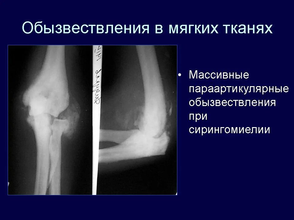 Обызвествление сухожилий мышц. Обызвествление связок локтевого сустава рентген. параартикулярные мягкие ткани тазобедренного сустава. обызвествление мягких тканей тазобедренного сустава. обызвествление мягких тканей тазобедренного сустава рентген.