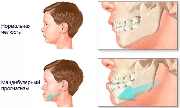 Мезиальный прикус и внчс. Дистальный прикус (птичий профиль). Ортогнатическая дистальный прикус. Мезиальный прикус и внчс. Мезиальный, глубокий, дистальный прикус.
