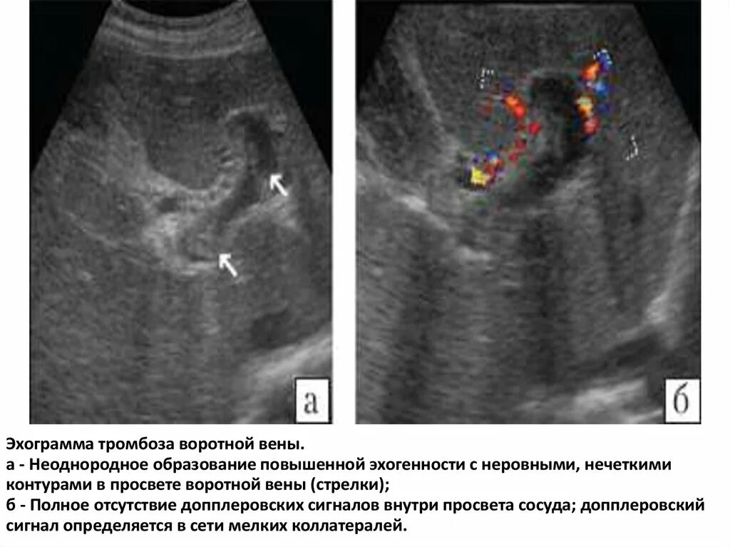 Расширение селезеночных вен. Тромбоз селезеночной вены на УЗИ. Тромбоз воротной вены на УЗИ. Тромбоз портальной вены УЗИ. Тромб в воротной Вене на УЗИ.