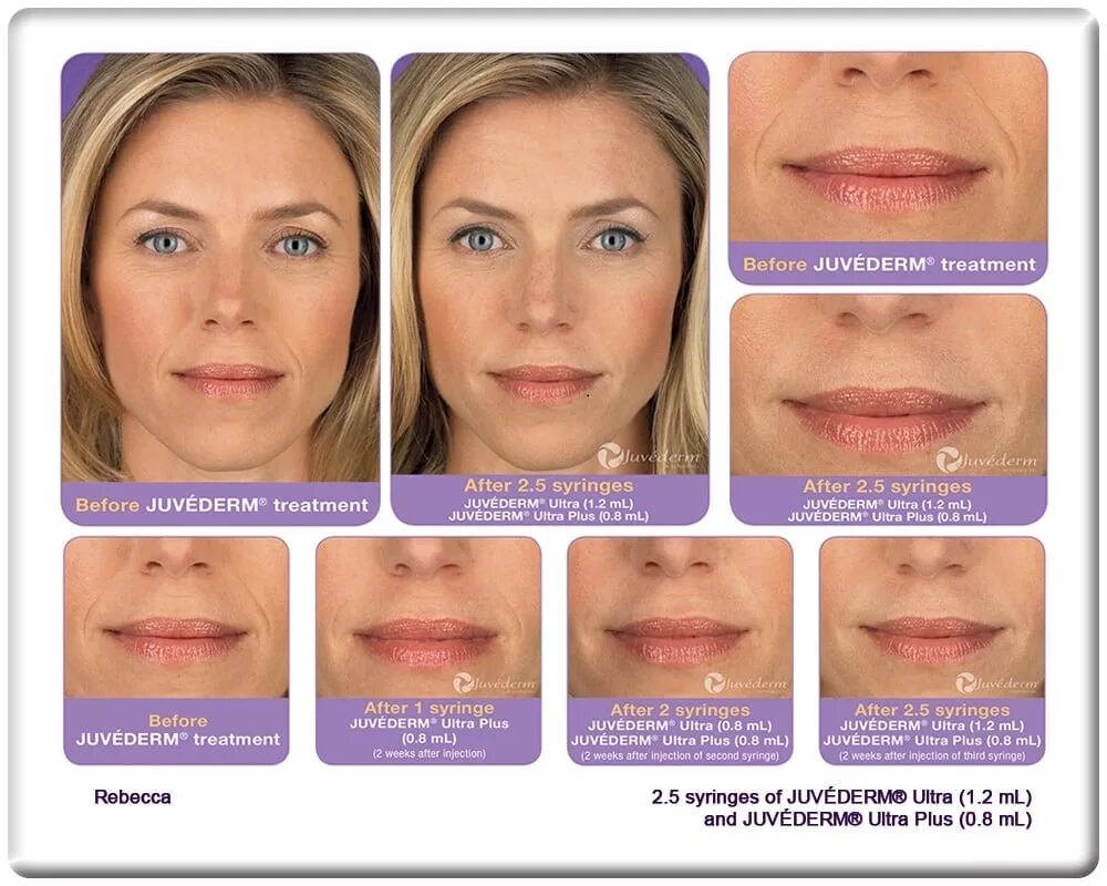 Филлер в губы форум. Juvederm Ultra smile, Juvederm Ultra 3. Филлер Ювидерм 0.5 мл.