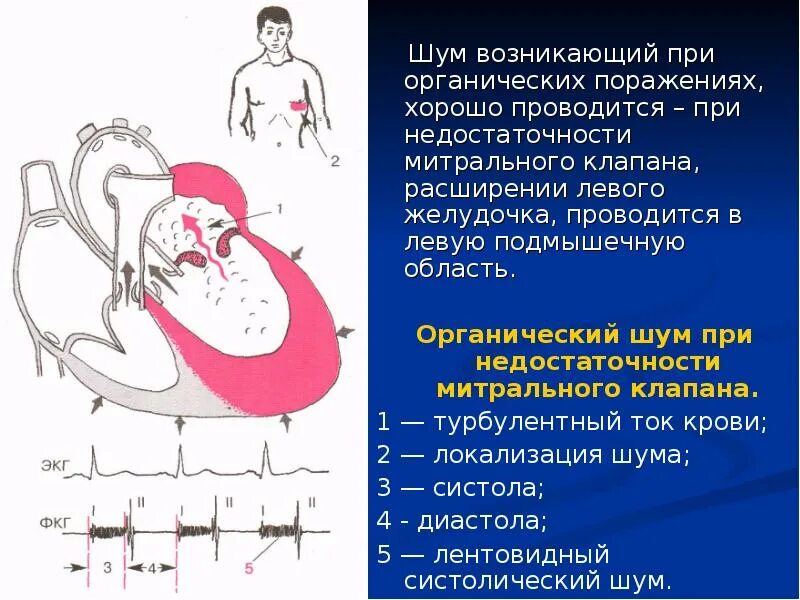 Митральная недостаточность шум. Характеристика шумов при недостаточности митрального клапана. Митральная недостаточность аускультация. Аускультация при недостаточности митрального клапана. Сердечные тоны шумы