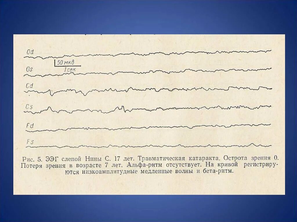 Заключение ээг при аутизме. Ээг ребенка аутиста. Показатели при аутизме ээг. Электроэнцефалограмма нормальные параметры фоновая ээг. Ритмы ээг график.