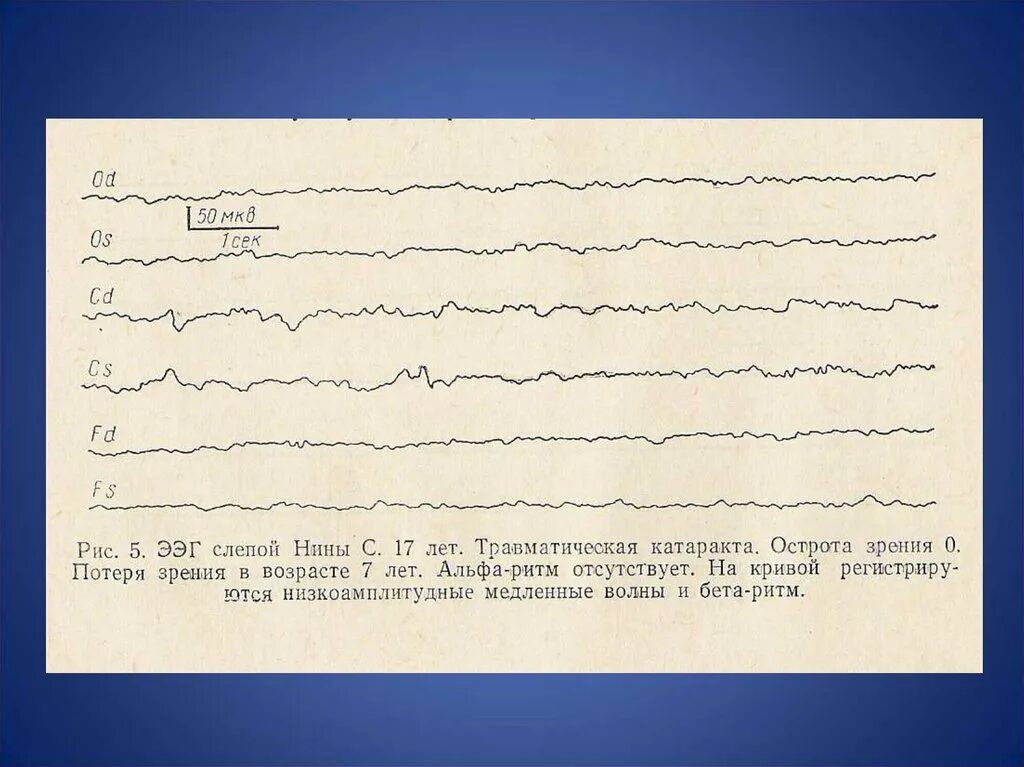 Низкоамплитудная ээг. ЭЭГ 150 МКВ расшифровка. Альфа ритм на ЭЭГ У детей норма и нарушения. МКВ В ЭЭГ это. ЭЭГ при аутизме у детей.