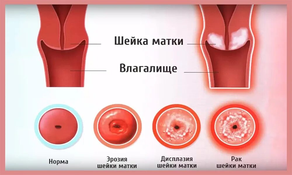 Влагалище Нерожавшей Женщины