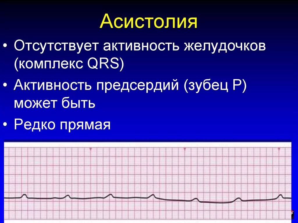 Асистолия сердца это. ЭКГ признаки асистолии желудочков. Желудочковая асистолия на ЭКГ. Асистолия на кардиограмме. Асистолия сердца на ЭКГ.