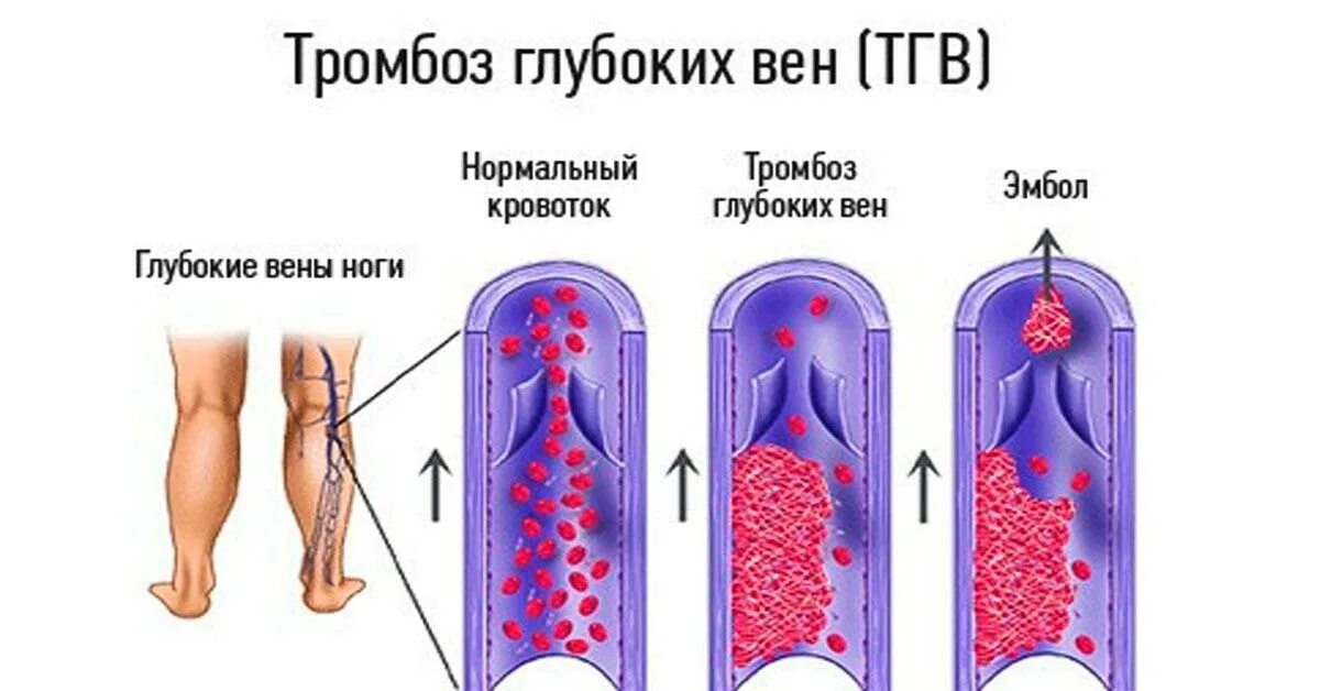 Проблемы с тромбами