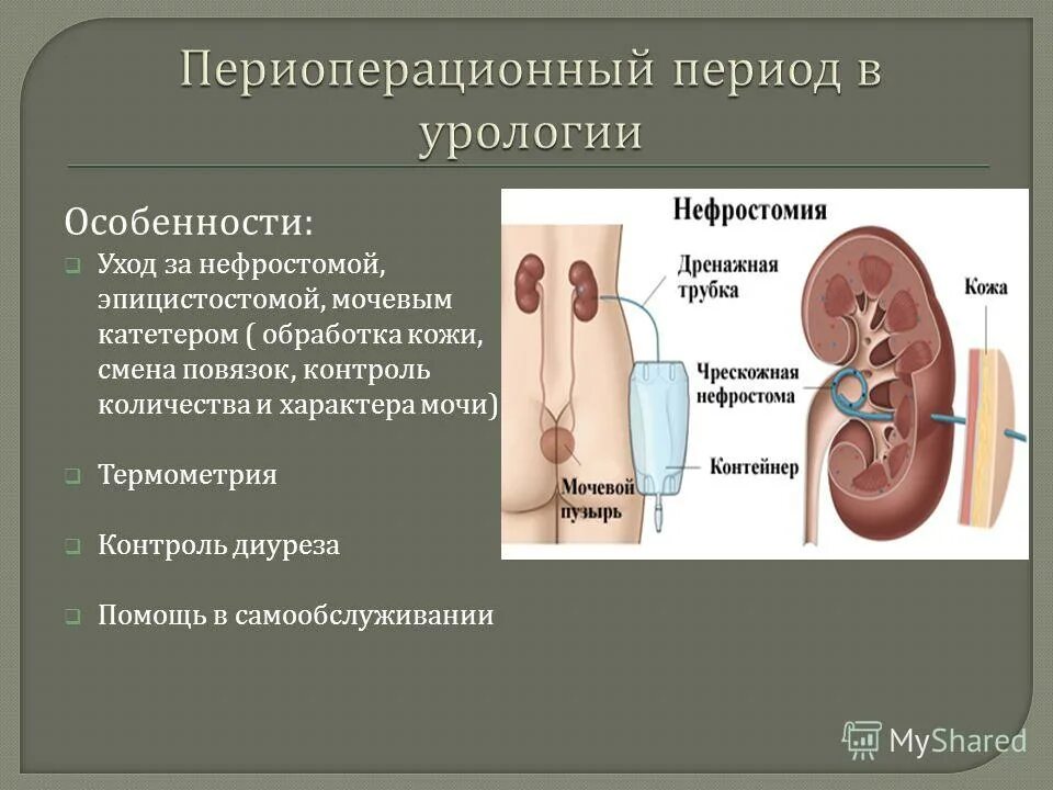 Порядок по урологии. Чрескожная нефростома. Нефростома в мочевом пузыре что это.