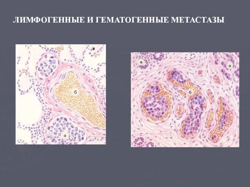 Гематогенное метастазирование. Лимфогенное метастазирование. метастазирование опухолей лимфогенное микропрепарат. этиология опухолей патанатомия.