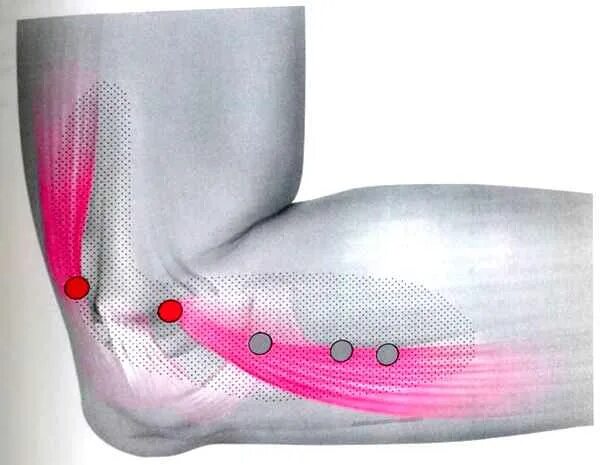 Эпикондилит локтевого сустава мкб 10. Эпикондилит локтевого сустава таблетки. Эпикондилит локтевого сустава таблетки. Бандаж thuasne 7010. Эпикондилита локтевого сустава.
