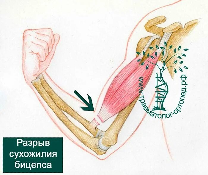 Разрыв сухожилия плечевого сустава. Разрыв сухожилия бицепса. Растяжение сухожилия бицепса.