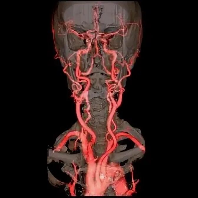Магнитно-резонансная ангиография сосудов шеи. Брахиоцефальные артерии анатомия. Мрт ангиография артерий шеи. Ангиограмма сонной артерии.