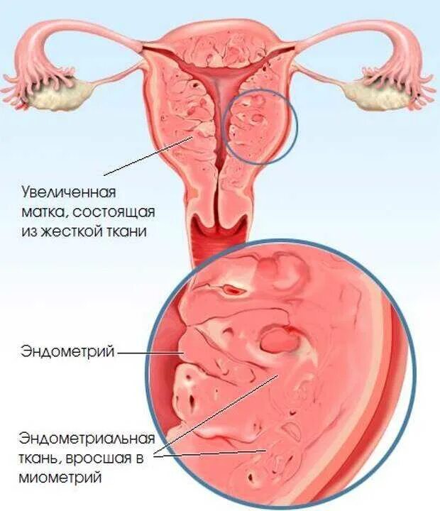 При аденомиозе можно забеременеть. Аденомиозный цервицит. Эндометриоз тела матки (аденомиоз).