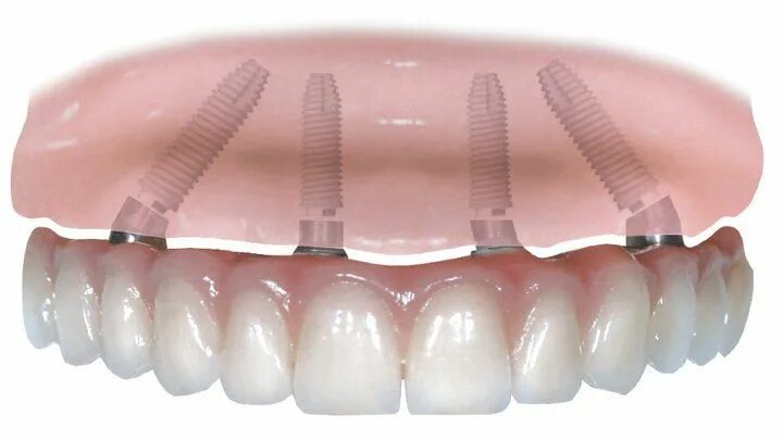 имплантация челюсти на 6 имплантах. протезы на 4 х имплантах. несъемные зубные протезы на 4 имплантах. имплантация all on 4 челюсть. протезы на 4 х имплантах.