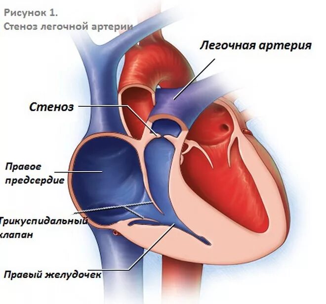 В легочной артерии содержится. Изолированный клапанный стеноз легочной артерии. стеноз клапана легочного ствола. сужение устья легочной артерии. изолированный стеноз клапана легочной артерии..