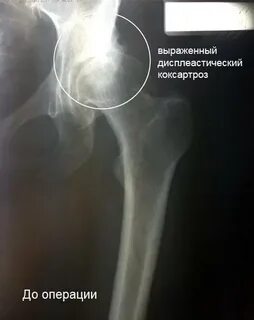 Что значит доа тазобедренного сустава