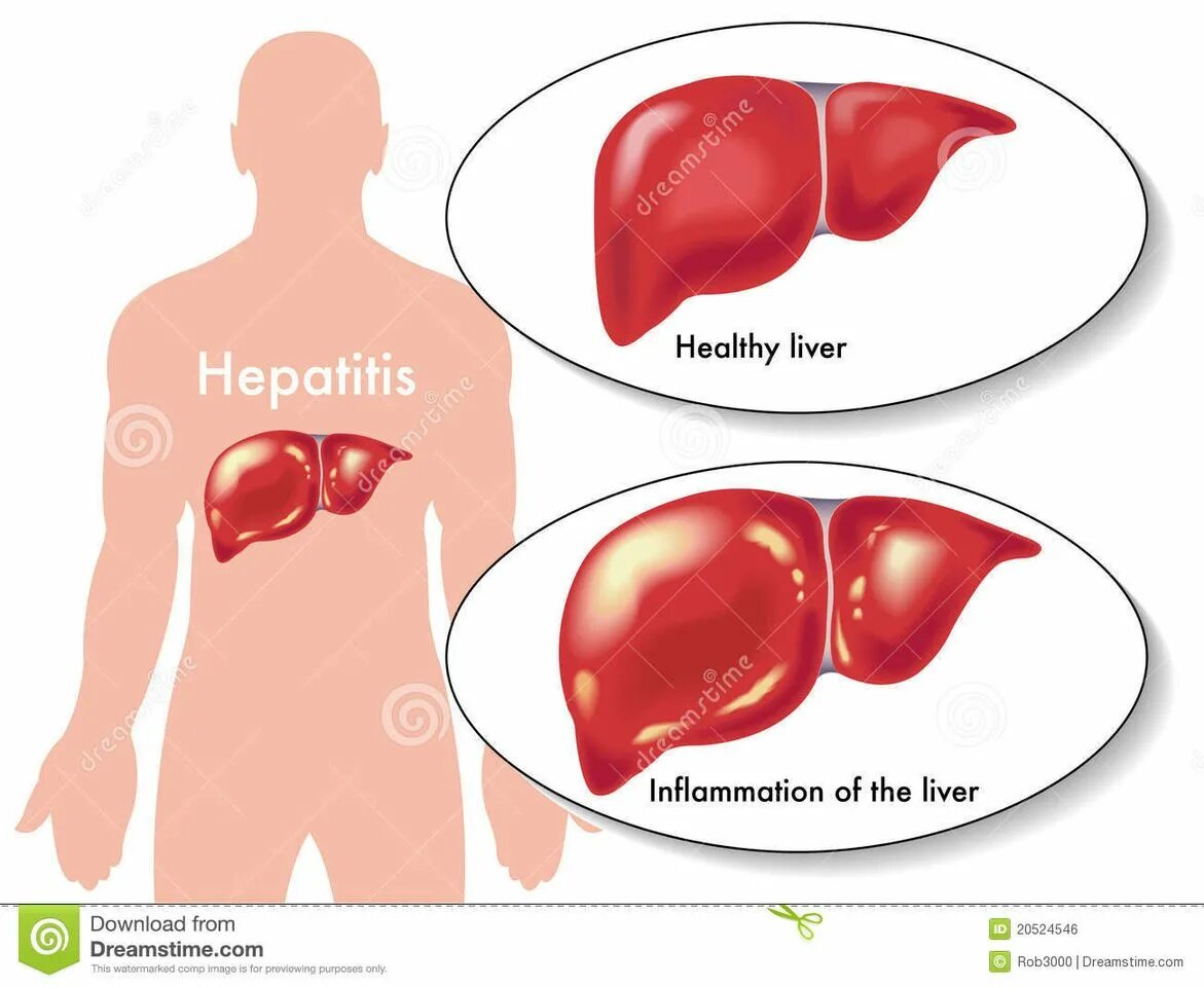 Печень пораженная гепатитом б. Вирусное поражение печени. Хронический реактивный гепатит.