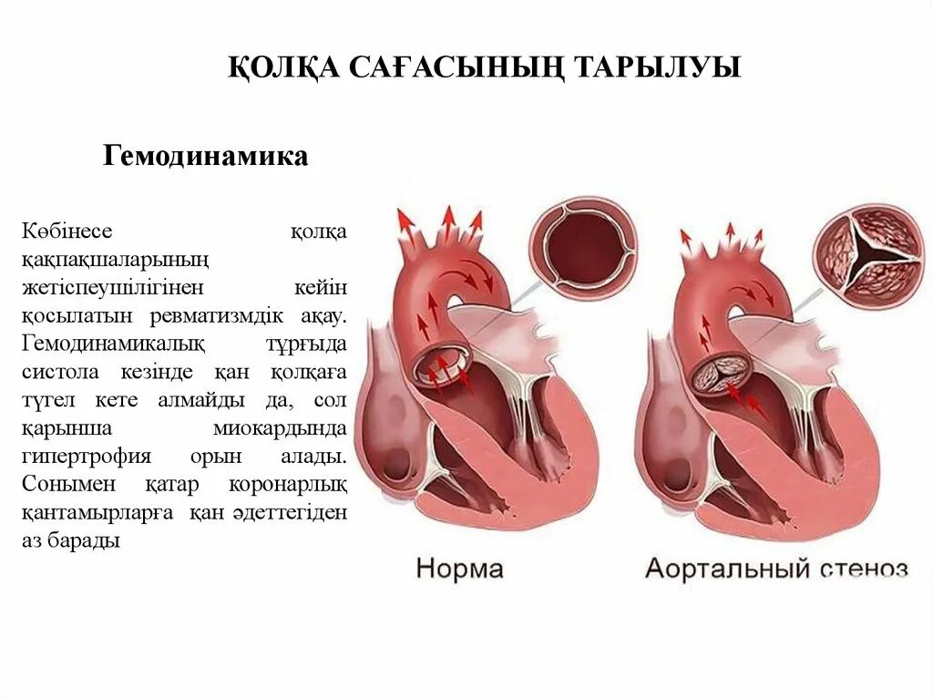 Пороки сердца аортальный стеноз и недостаточность. Врожденные пороки сердца аортальный стеноз. Аортальный стеноз патофизиология.