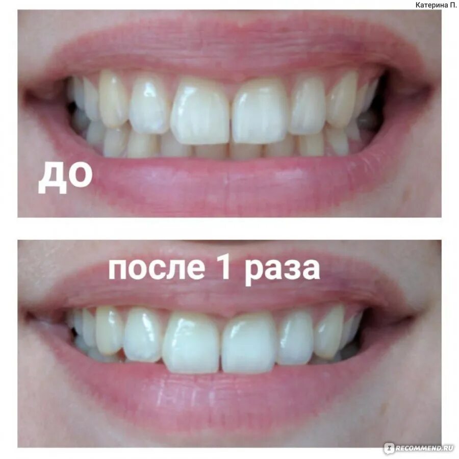 Отбеливание зубов. Полоски для отбеливания зубов до и после. Отбеливание полосками до и после. Отбеливание зубов до и после.