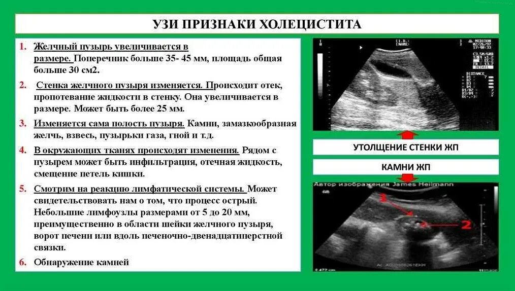 Какие исследования желчного пузыря