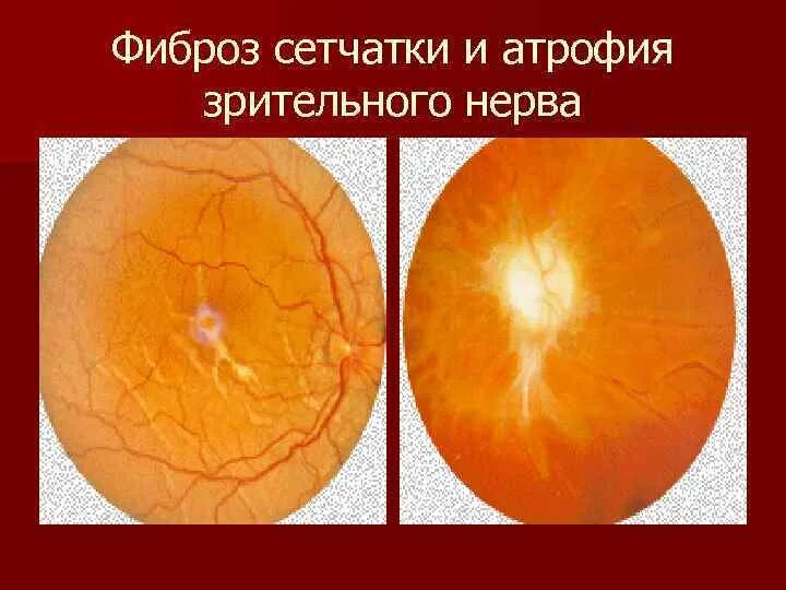 Эпиретинальный фиброз глаза. Эпиретинальный фиброз сетчатки глаза. Эпиретинальный мембрана. Эпимакулярный фиброз глаза что это. Эпиретинальный фиброз офтальмоскопия.