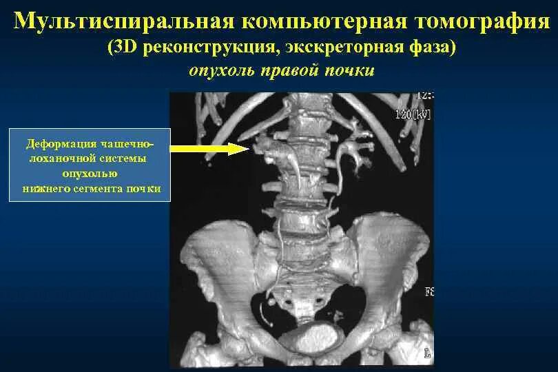 Опухоли почечной паренхимы и верхних мочевых путей