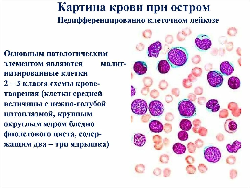 Хронический миелоидный лейкоз картина крови. Острый лейкоз мазок крови. Острый миелоидный лейкоз картина крови. Острый миелобластный лейуозкартина крови.