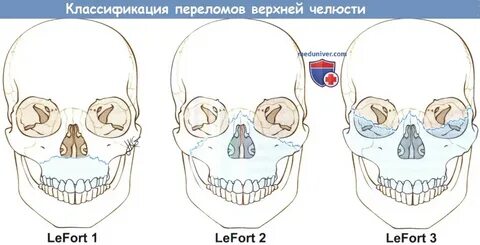 Сломана верхняя